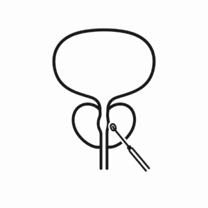 Prostate (HoLEP)